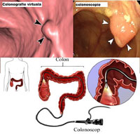 Colonoscopie