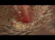MEDICAL - How cholesterol clogs your arteries (atherosclerosis)